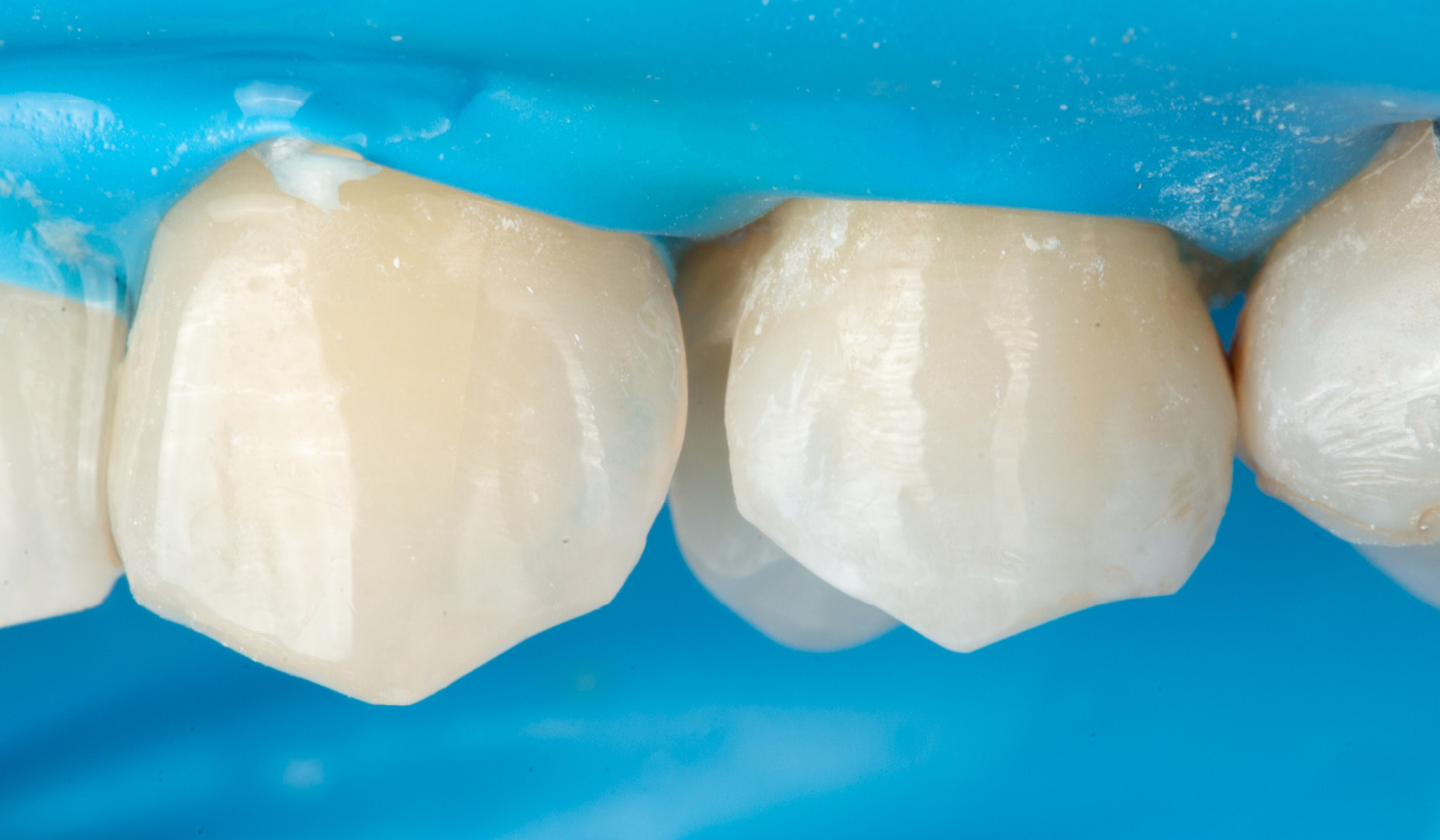 Fig. 5: Buccal view of the teeth after deep margin elevation with universal products